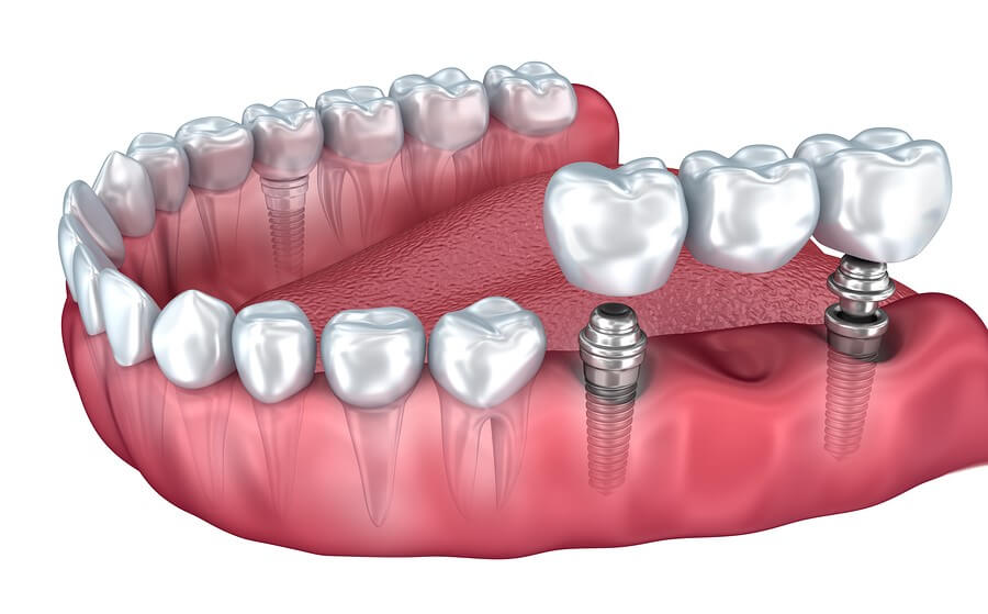 Multiple Teeth Implants – Old Mill Dental