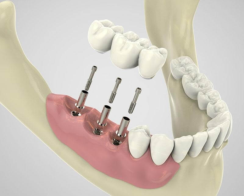 Dental Implants Mandurah | Gentle Dentists | Platinum Smile Dental Centre