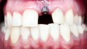 What Are the Different Single-Tooth Replacement Options?