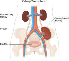 Kidney Transplant cost in India