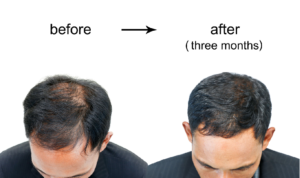 Redefining Hair Loss Recovery