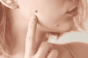 skin tag