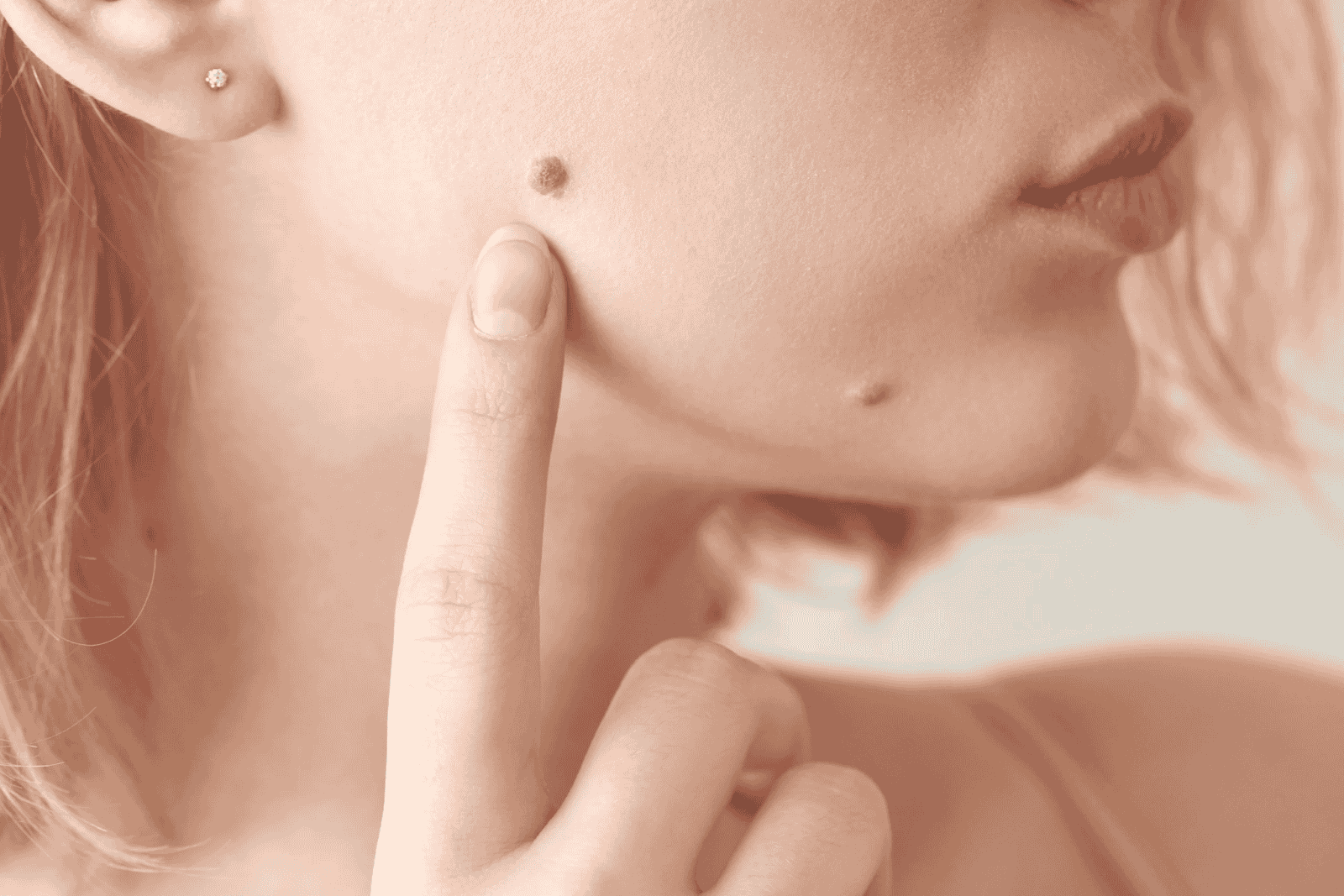skin tag